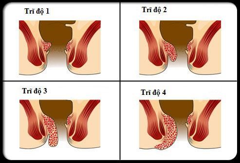 Dấu hiệu nhận biết bệnh trĩ