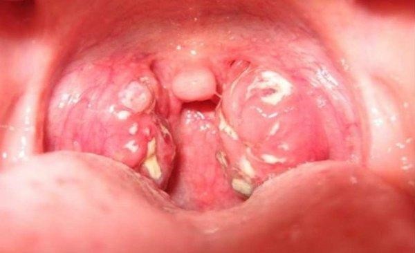 Dấu hiệu nhận biết cơ bản của bệnh bạch hầu