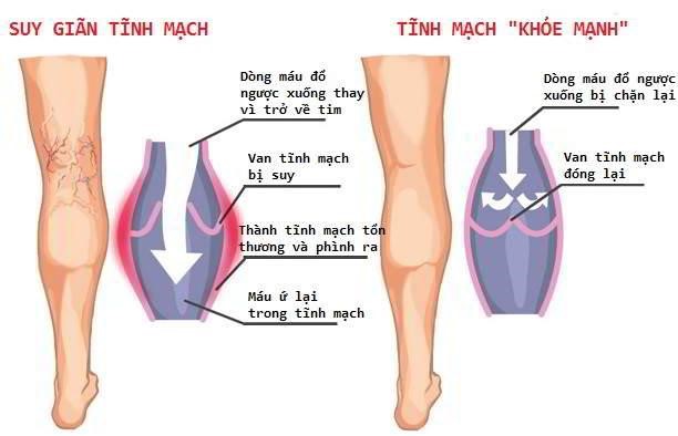 Dấu hiệu suy, giãn tĩnh mạch