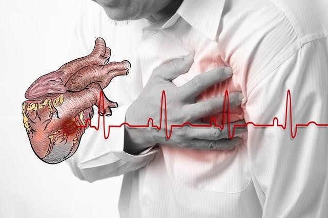 Đau thắt ngực là triệu chứng của bệnh nhồi máu cơ tim