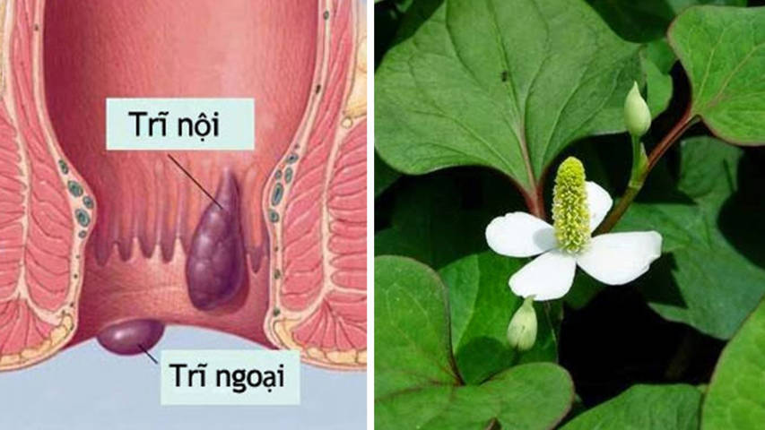 Điều trị bệnh trĩ bằng thuốc đặc trị