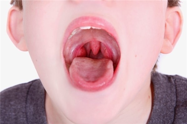 Sau khi điều trị xạ trị miệng sẽ bị khô