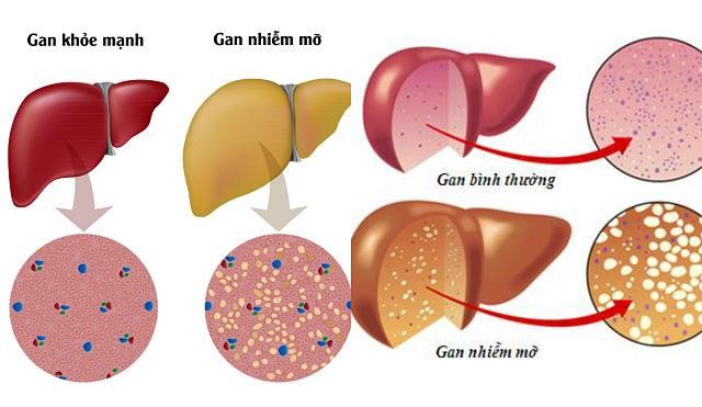 Từ gan nhiễm mỡ có thể biến chứng sang xơ gan