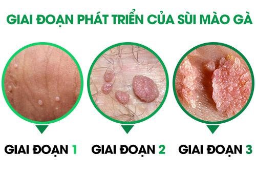Giai đoạn bắt đầu phát hiện triệu chứng bệnh mồng gà