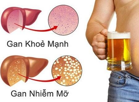 Hạn chế sử dụng rượu bia để bảo vệ gan