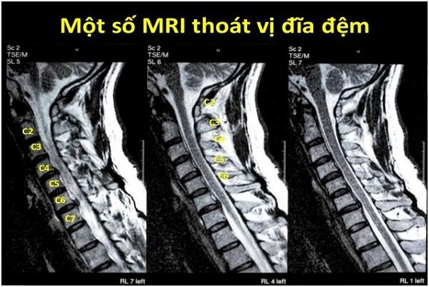 Hình ảnh MRI thoát vị đĩa đệm cột sống cổ