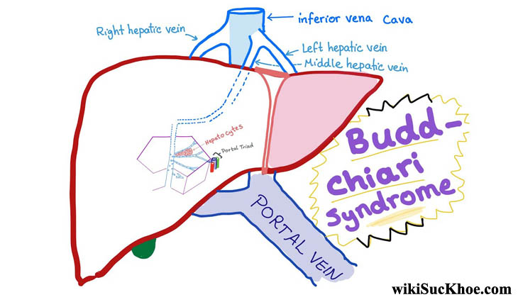 Hội chứng Budd – Chiari: Khái niệm, nguyên nhân, biểu hiện,điều trị và cách phòng ngừa
