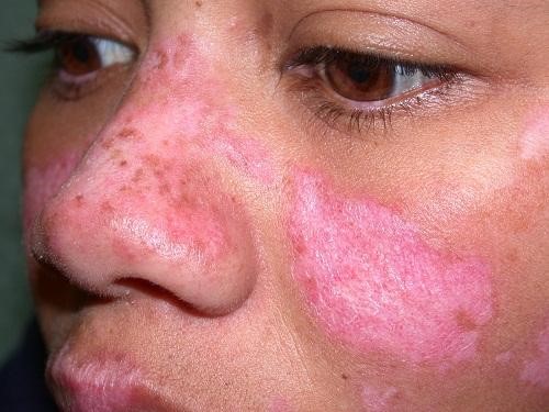 Lupus ban đỏ một bệnh về da phổ biến