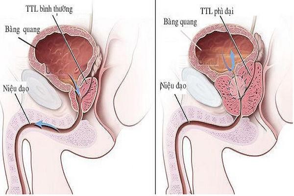 Hình minh họa tăng sản lành tính tuyến tiền liệt