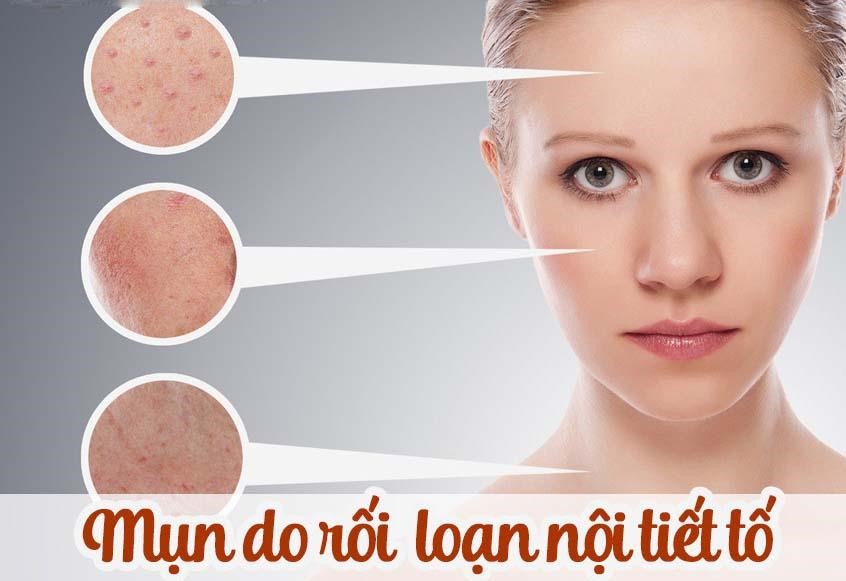 Mọc nhiều mụn là triệu chứng thường gặp khi bị rối loạn nội tiết tố