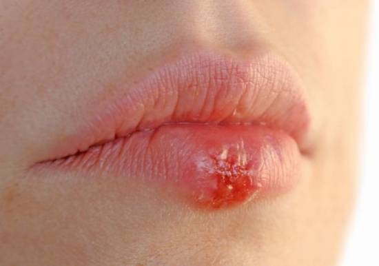Mụn rộp sinh dục có thể ở miệng