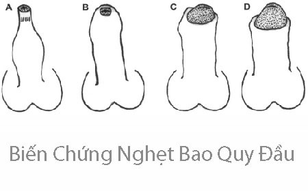Biến chứng của nghẹt bao quy đầu