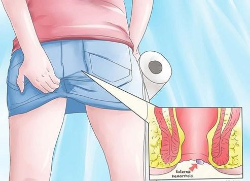 Ngứa hậu môn khiến người bệnh thiếu tự tin trong cuộc sống