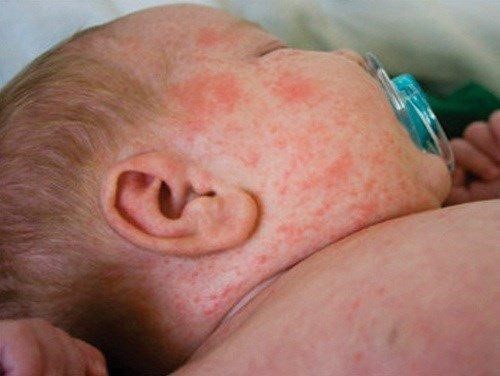 Người mắc bệnh viêm não mô cầu bị nổi mẩn đỏ khắp người