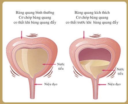 Nguyên nhân của bệnh tiểu nhiều, tiểu buốt so bàng quang bị ép chặt