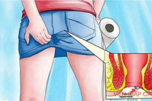 Nguyên nhân chủ yếu dẫn đến bệnh trĩ