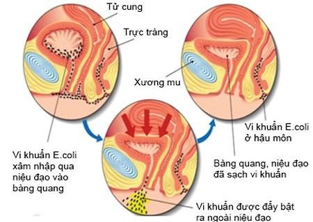 Nguyên nhân chủ yếu gây viêm đường tiết niệu do vi khuẩn E.coli