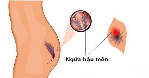 Nhiều nguyên nhân gây ra bệnh ngứa hậu môn