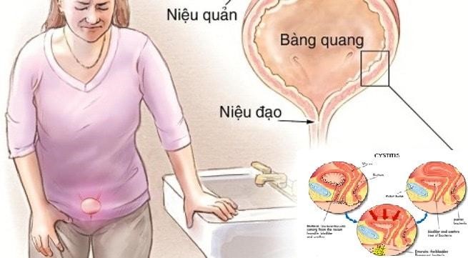 Nguyên nhân gây ra bệnh viêm niệu đạo