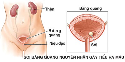 Nguyên nhân gây ra tình trạng viêm bàng quang