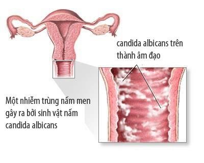 Nguyên nhân gây viêm nhiễm âm đạo