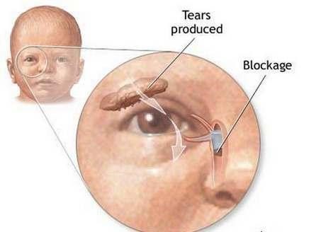 Nguyên nhân và những điều nên biết về bệnh tắc tuyến lệ