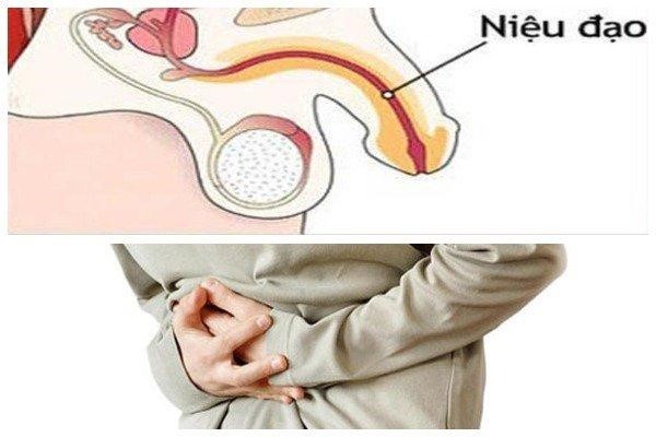 Nhiễm khuẩn đường sinh dục là nguyên nhân gây bệnh viêm niệu đạo nam giới