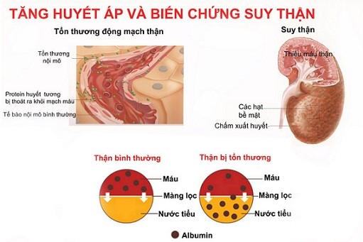 Những biểu hiện thường thấy của viêm cầu thận