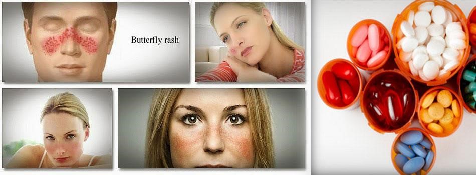 Phương pháp điều trị lupus ban đỏ