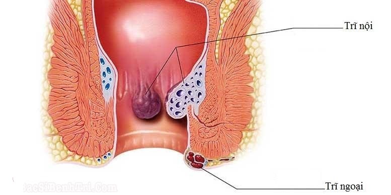 Phương pháp điều trị bệnh trĩ hiệu quả