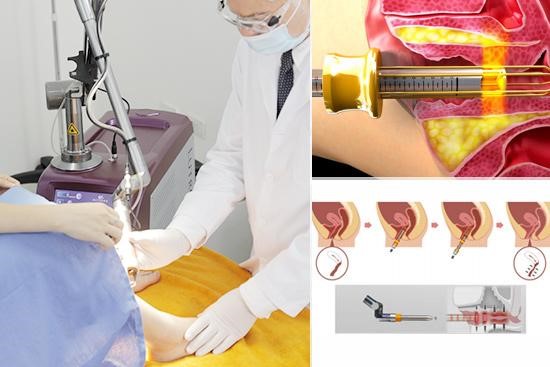 Quy trình tiểu phẫu thu nhỏ âm đạo