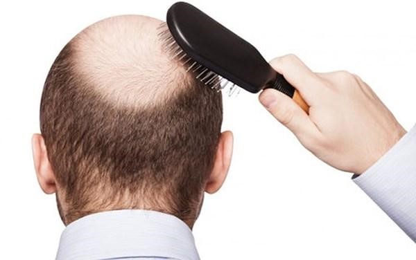 Rụng tóc là dấu hiệu rối loạn nội tiết tố thường gặp ở nam giới