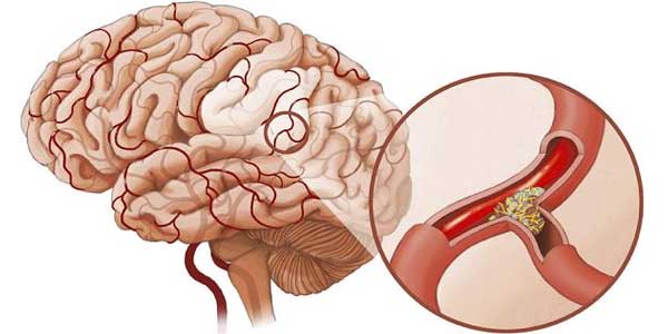 Bệnh tai biến mạch máu não: nguyên nhân, triệu chứng và biện pháp hỗ trợ điều trị bệnh tại nhà hiệu quả