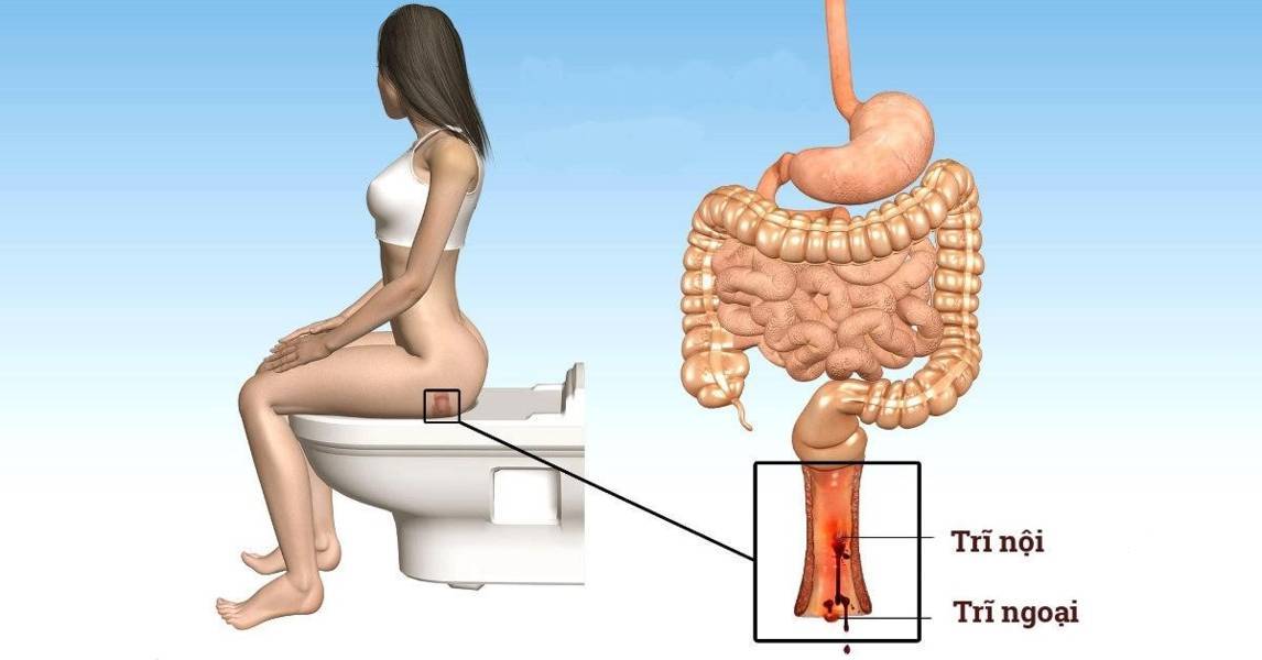 Táo bón cũng là nguyên nhân gây bệnh