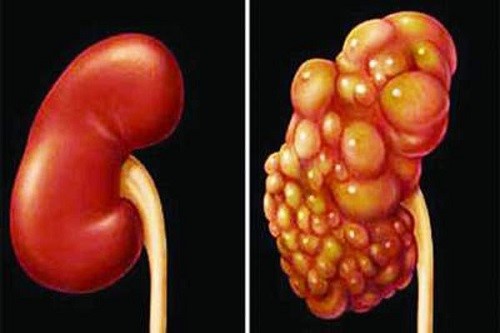 Thận của người bình thường và thận của người bị bệnh