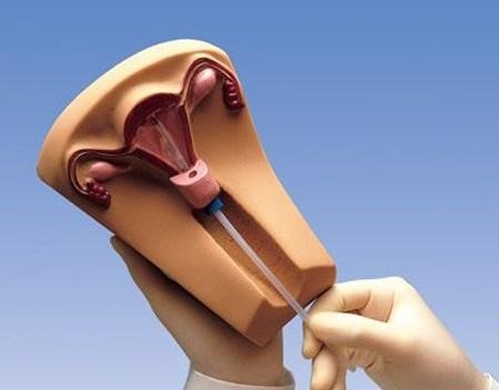 Chị em nên tháo vòng tránh thai khi đã bước vào thời kì mãn kinh