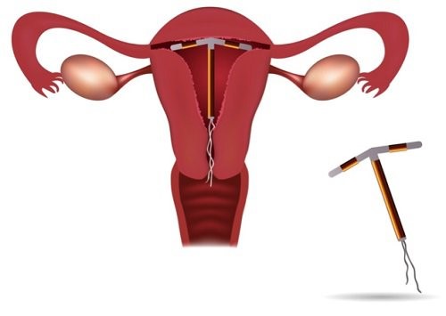 Những thay đổi của cơ thể sau khi tháo vòng