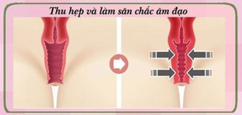 Thu nhỏ âm đạo