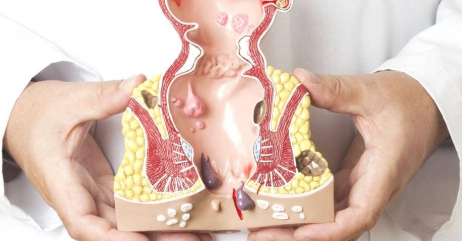 Nên thực hiện ăn uống và sinh hoạt khoa học để phòng chống bệnh trĩ