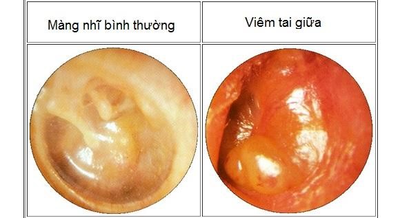 Tìm hiểu về bệnh viêm tai giữa