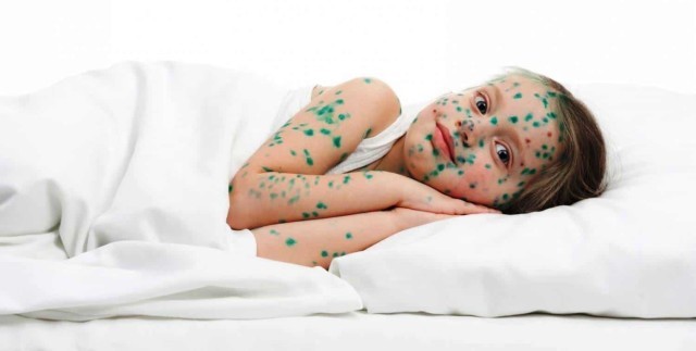Trẻ nhỏ có nguy cơ mắc thủy đậu cao hơn