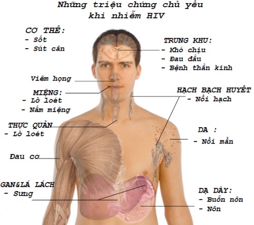 Triệu chứng bệnh HIV/AIDS