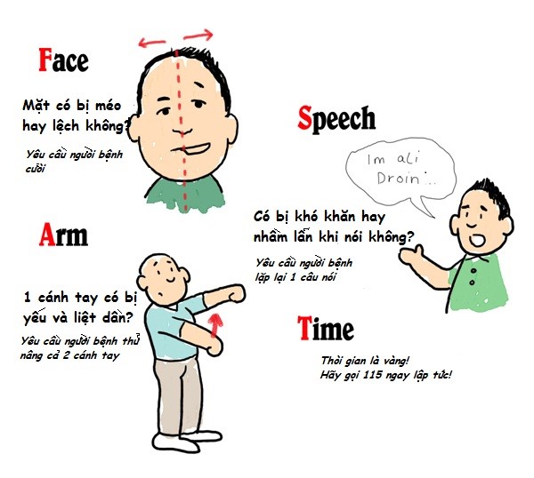 Triệu chứng của bệnh đột quỵ