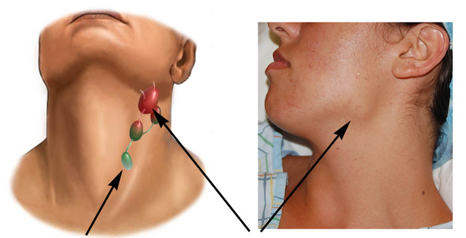 Triệu chứng nhận biết bệnh