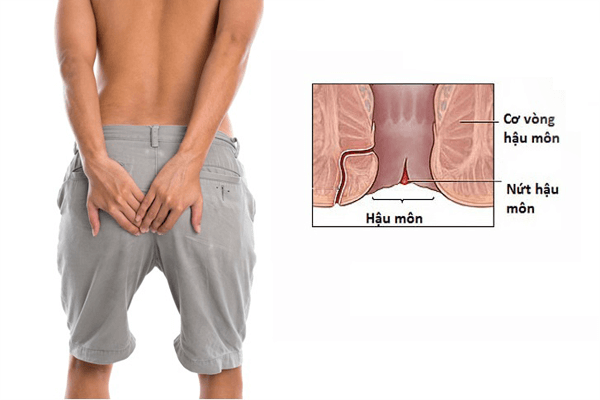 Một số triệu chứng bệnh kẽ hậu môn