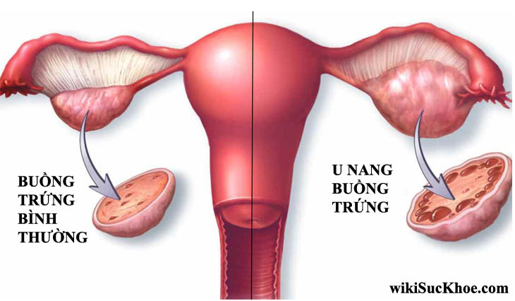Bệnh u nang buồng trứng: Khái niệm, nguyên nhân, biểu hiện, điều trị, cách phòng ngừa