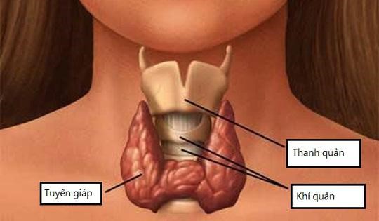Bệnh u nang tuyến giáp là gì?