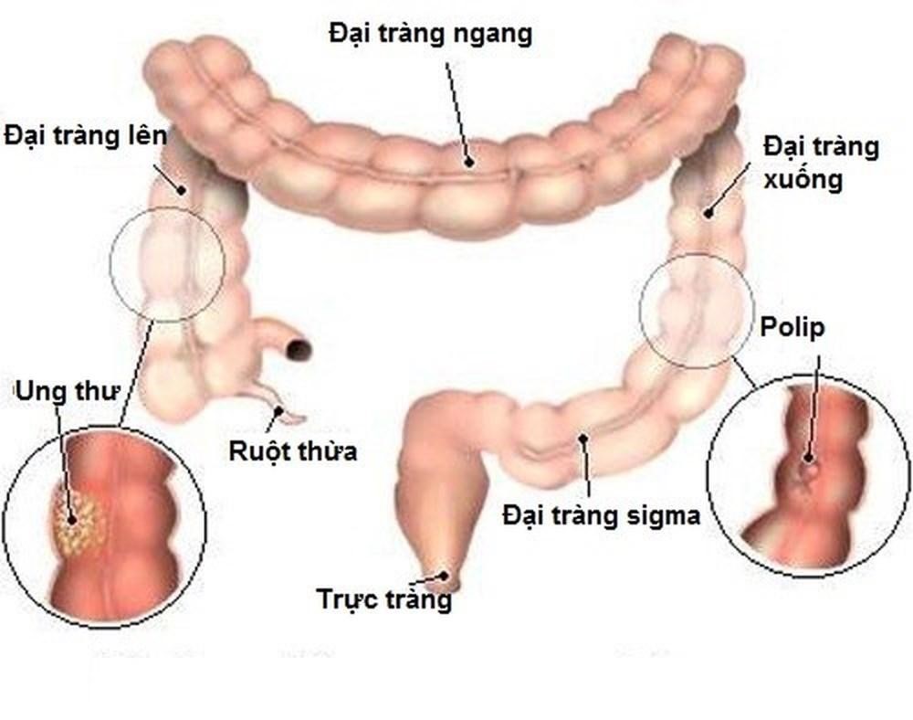 Ung thư đại trực tràng có nguy cơ dẫn đến tử vong cao