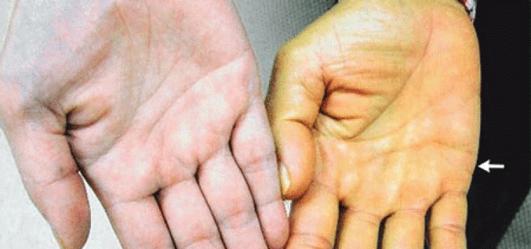 Vàng da là một trong những dấu hiệu của bệnh ung thư gan