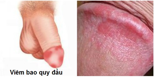 Hiện tượng viêm bao quy đầu